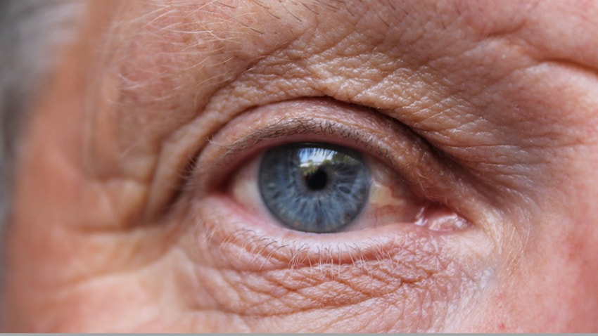 What is age-related macular degeneration?